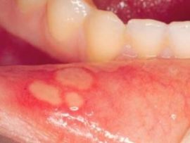 Ulcerative stomatitis