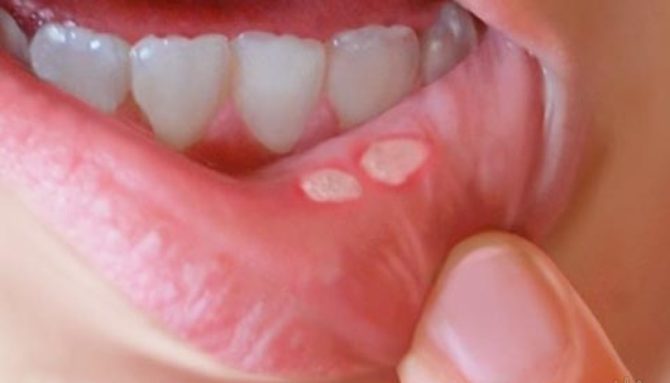 Ulcerații ale gurii