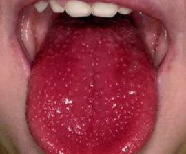 Scarlet fever tongue