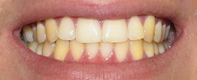 Gelbe Zähne