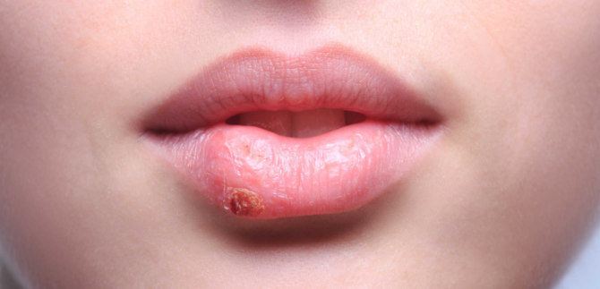 Maladie des lèvres