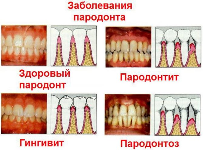 Parodontálna choroba