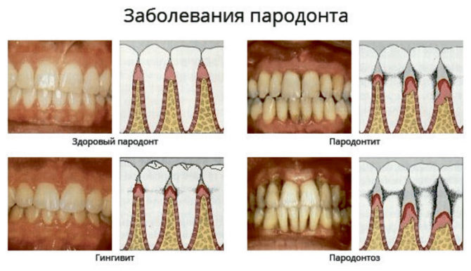 Boala parodontala