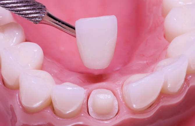 استبدال تاج الأسنان
