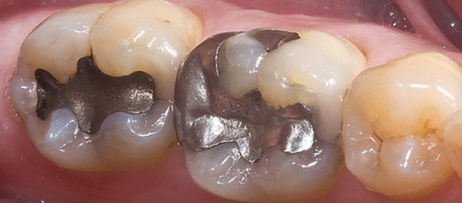 Sealed teeth