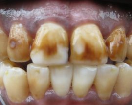 Laufende Zahnfluorose