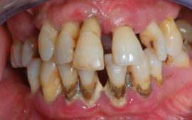 zahájená ochorenia parodontu
