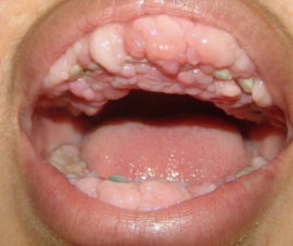 Cancer buccal