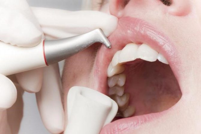 Završna faza pranja zuba pomoću Air Flow tehnologije