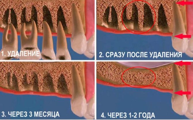 Healing of the hole after tooth extraction