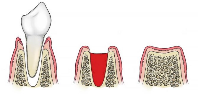 Léčení díry po extrakci zubu