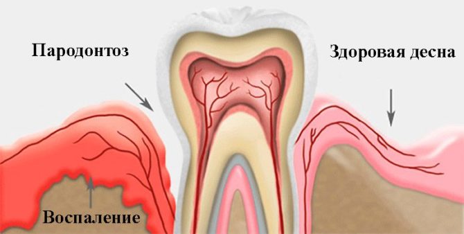 Gencives saines et maladie parodontale