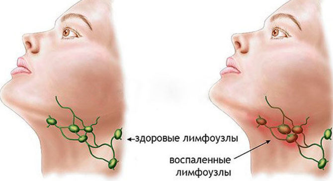 Healthy and inflamed lymph nodes