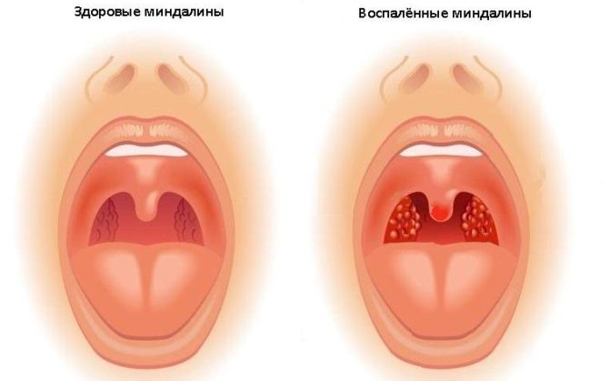 Sihat dan sakit tonsil