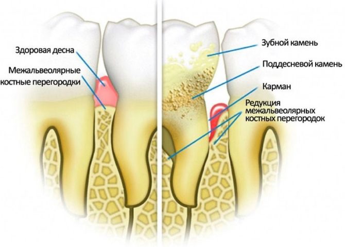 Dientes sanos y enfermedad periodontal.