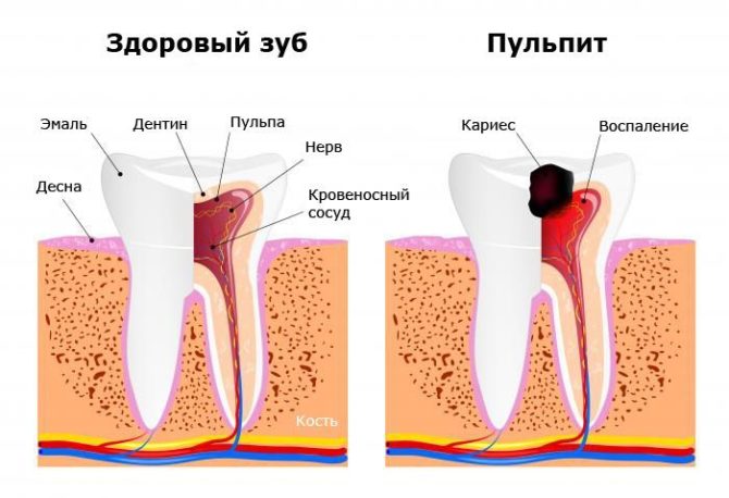 Healthy tooth and pulpitis tooth