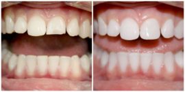 Dente prima e dopo l'estensione con fotopolimero