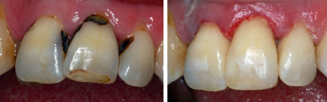 Dent avec carie cervicale avant et après traitement
