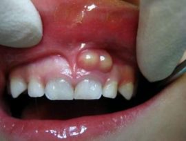 Tooth cyst