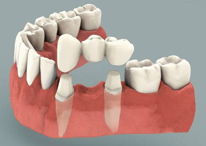 Three-tooth bridge