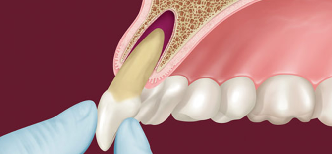 Dantų alveolės