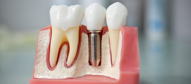 Implantes dentales y dientes convencionales.