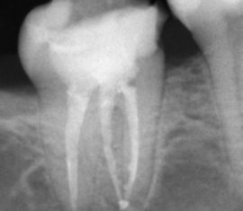 Canali dentali a raggi X.