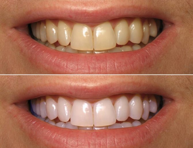 Teeth before and after brushing with soda