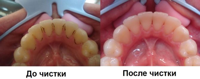 Teeth before and after ultrasonic cleaning