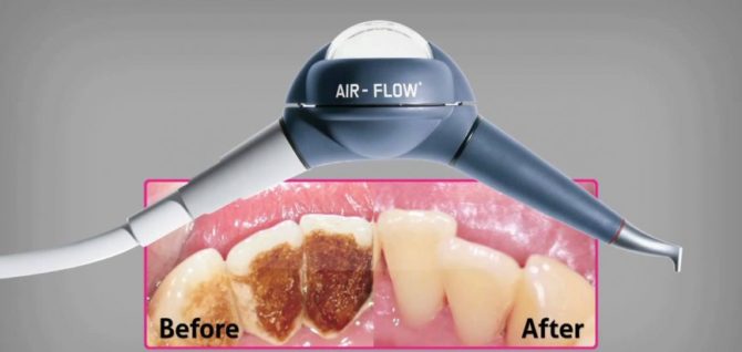 Dentes antes e depois da escovação usando a tecnologia Air Flow