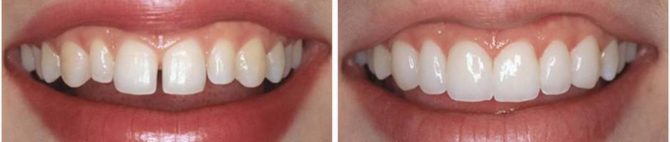 Tænder før og efter kunstgendannelse