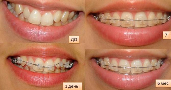 Dents avant et après le port d'un appareil dentaire