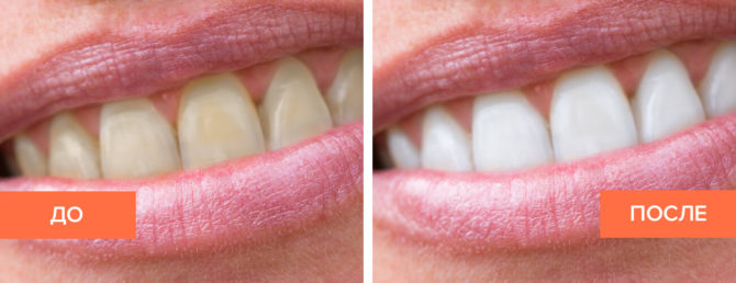 Dentes de carvão ativado antes e depois