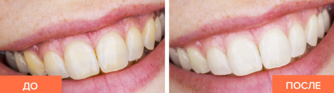 Dents avant et après la décoloration au bicarbonate de soude