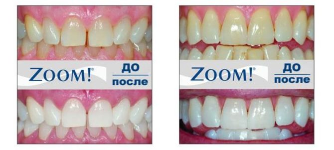 Gigi sebelum dan selepas pemutihan menggunakan teknologi ZOOM