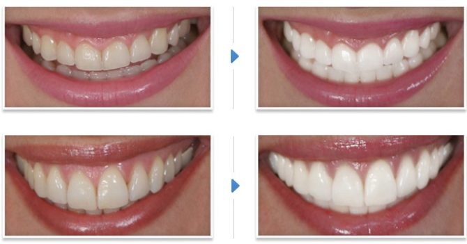 Zuby před a po bělení v zubním lékařství