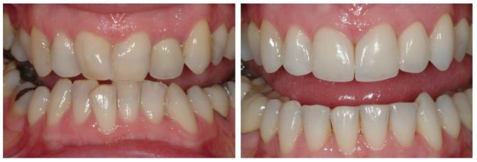 Răng trước và sau khi áp dụng nắp