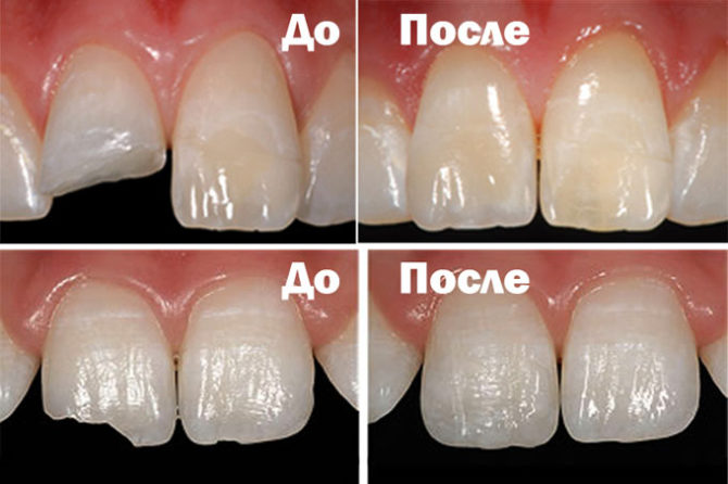 Teeth before and after restoration with composite materials