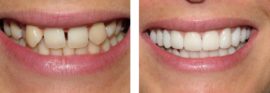 Teeth before and after restoration with veneers