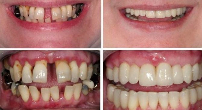 Dents avant et après attelle avec couronnes céramique-métal