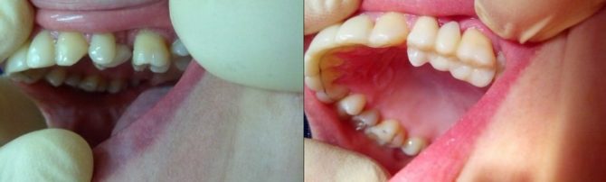 Teeth before and after splinting with fiberglass