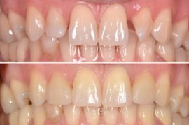 Denti prima e dopo l'installazione di faccette in porcellana