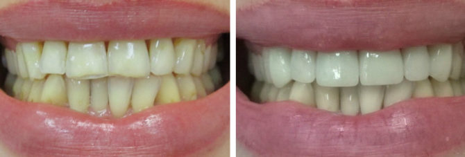 Teeth before and after the installation of ceramic crowns