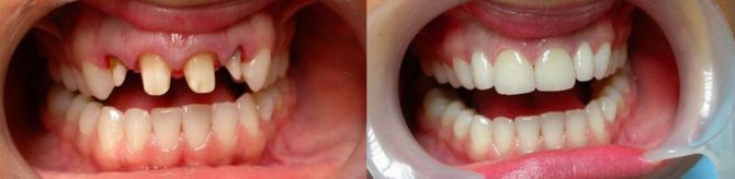 Dinții înainte și după instalarea coroanelor ceramico-metalice