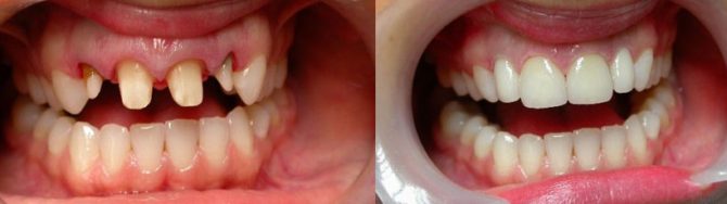 Zuby pred a po inštalácii koruniek z keramického kovu