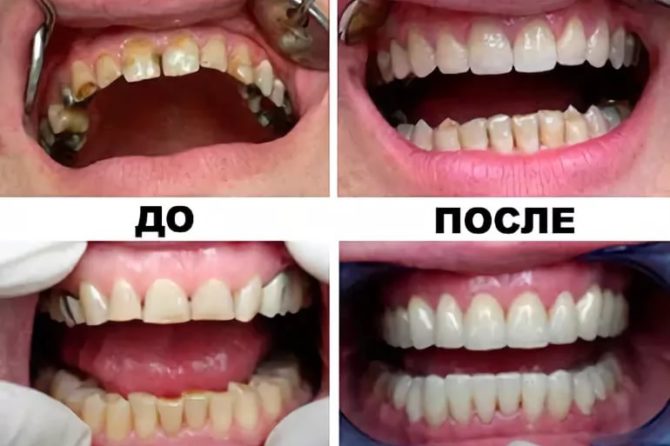 Zuby pred a po inštalácii koruniek z keramického kovu