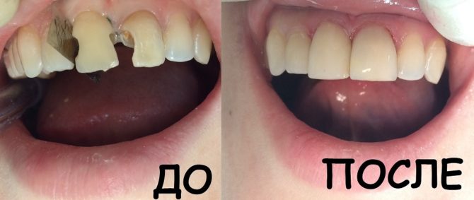 Teeth before and after installing light fillings
