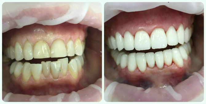 Dentes antes e depois da instalação de facetas de zircônio