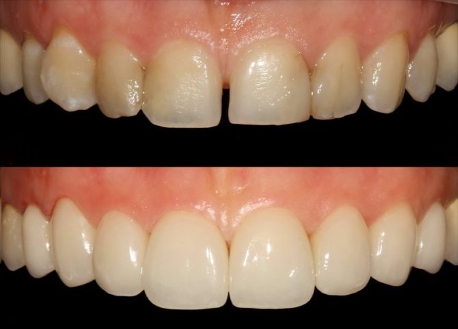 Răng trước và sau khi cài đặt veneers