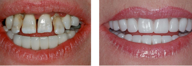 Tanden voor en na het plaatsen van fineer